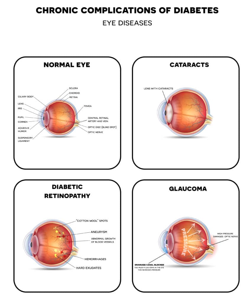 Eye complications of diabetes