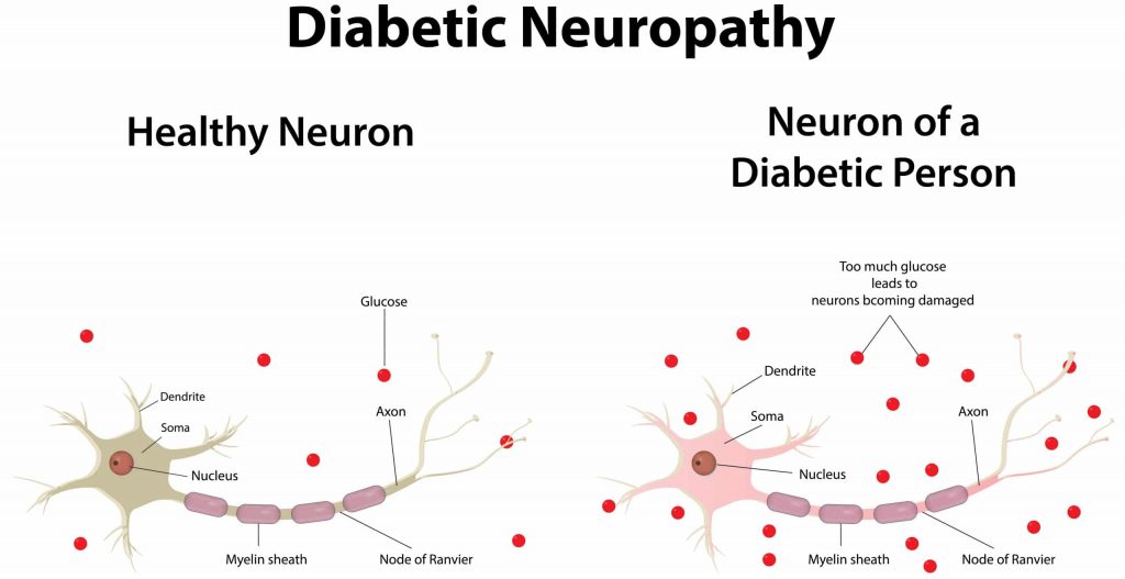 Diabetic neuropathy