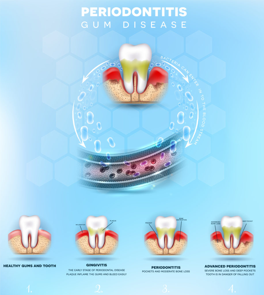 stages of gum disease