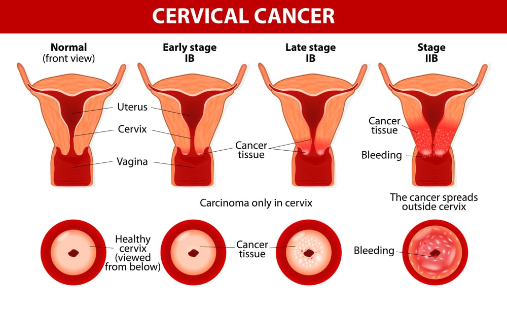 stages of cervical cancer