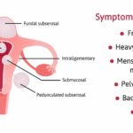 Fibroids: Symptoms, complications and treatment