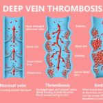 Deep vein thrombosis (DVT): Symptoms, diagnosis, treatment and more