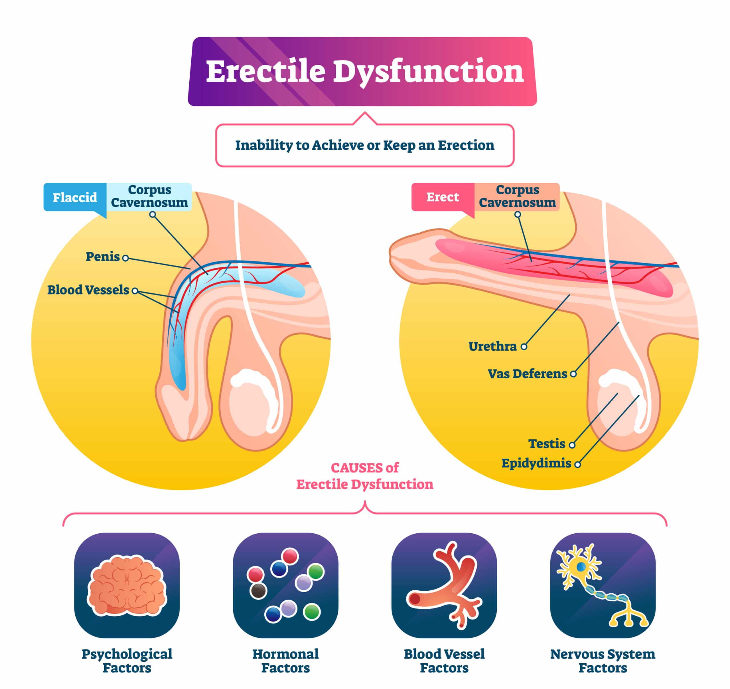 Causes of erectile dysfunction
