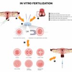 IVF: 5 step process,costs, risks, success rates and centres in Nigeria