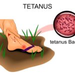 Tetanus: Dirty wounds aren’t the only culprits