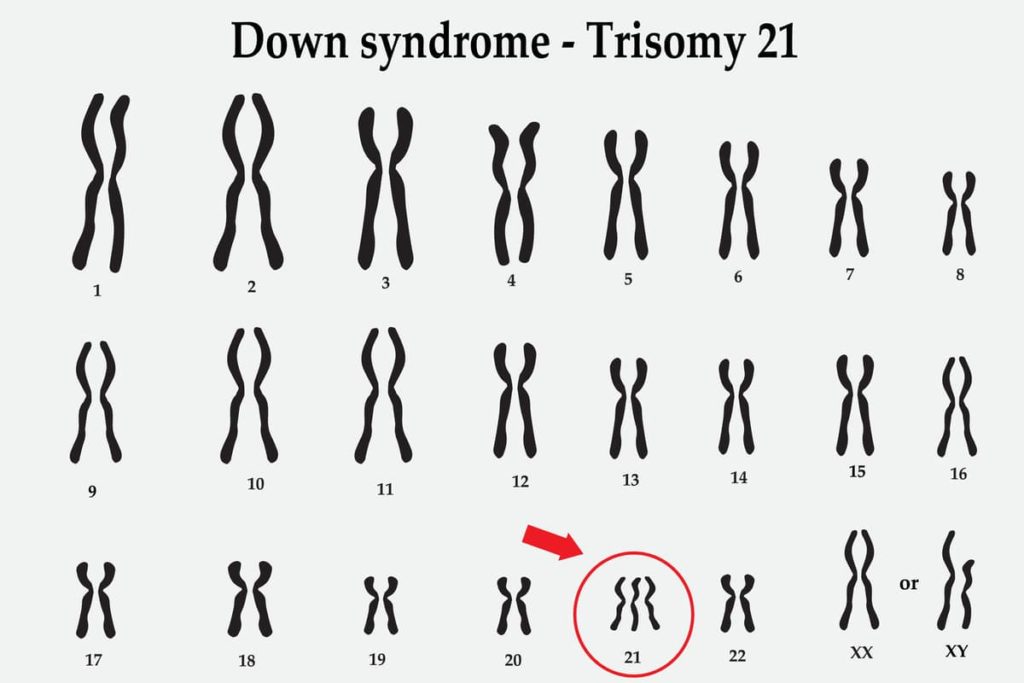 trisomy 21