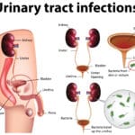 UTI-Urinary tract infections
