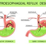 Gastro-oesophageal reflux disease (GORD)