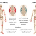 Rheumatoid arthritis vs osteoarthritis
